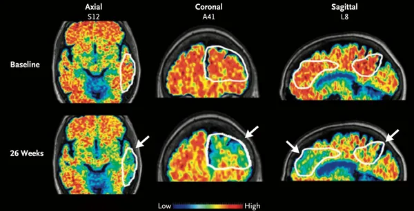 img of 阿尔茨海默病药物可能通过新的超声工具更快地进入大脑